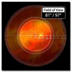 Volk 78D General Diagnosis and Laser Treatment Lens in Case with Manual Part # V78C