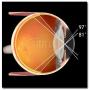 Volk 78D General Diagnosis and Laser Treatment Lens in Case with Manual Part # V78C