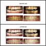 Inductive Charging Tooth whitening System Teeth Bleaching Light-Accelerated BleachingTrays Kit with 16 Powerful Red/Blue LED Lights (White)